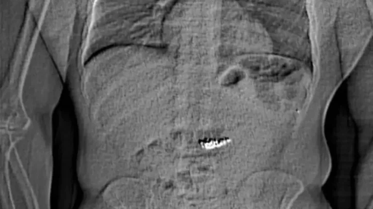 Rayos-X-de-Jaythan-Gilder-despues-del-robo